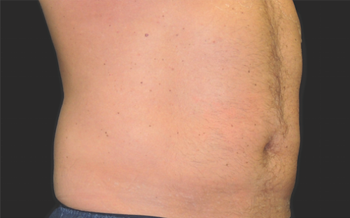 CoolSculpting Before After Photos |Vienna | Richmond VA