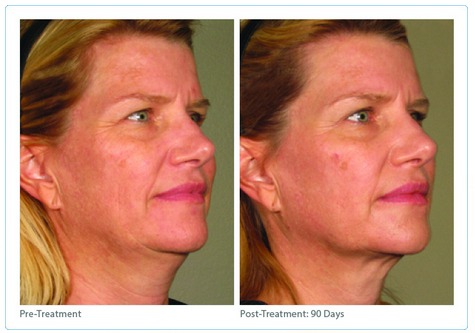 Non-Surgical Facelift with Infini and Ultherapy