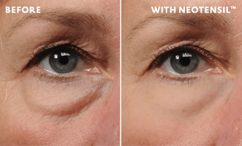 Non-surgical eye lift solution for your under-eye bags