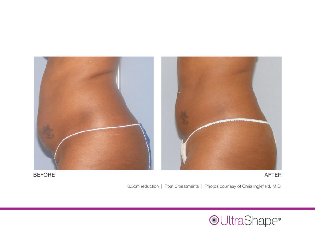How Much Does UltraShape Body Contouring Cost?