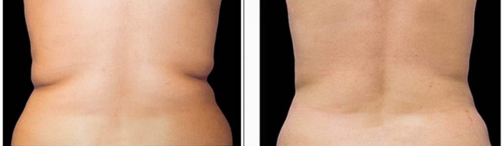 Surgical &amp; Non-Surgical Liposuction and Body Contouring Internet Special