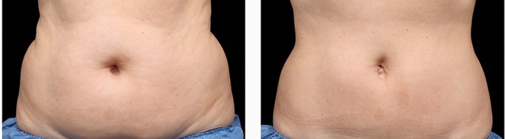 Surgical &amp; Non-Surgical Liposuction and Body Contouring Internet Special