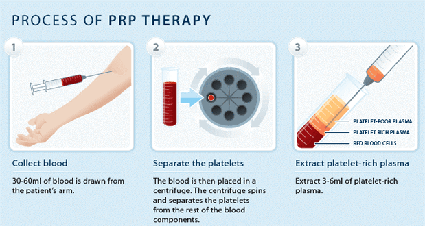 Growth Factor Hair Stimulation: Non-surgical Hair Loss Treatment (PRP Therapy)