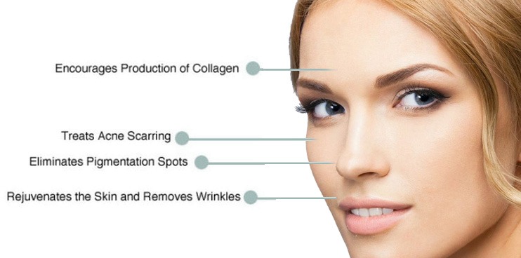 Microneedling Collagen Induction Therapy