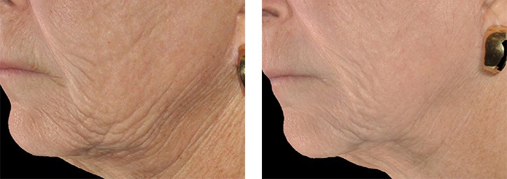 Chin Fat Reduction Option: Surgical and Non-Invasive