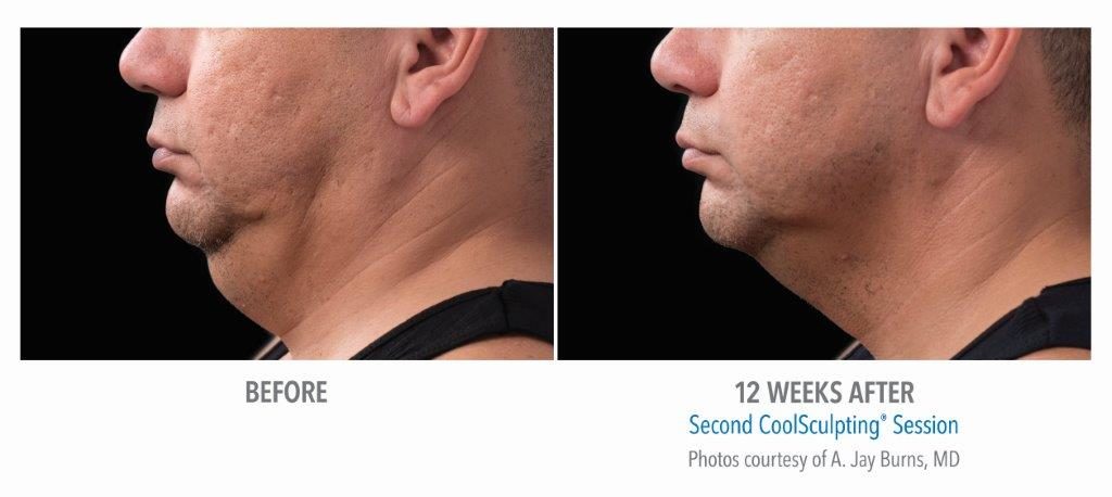 Chin Fat Reduction Option: Surgical and Non-Invasive