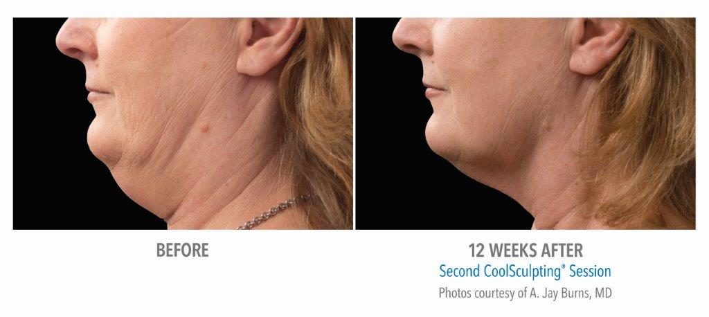 CoolSculpting® Before &amp; After Results