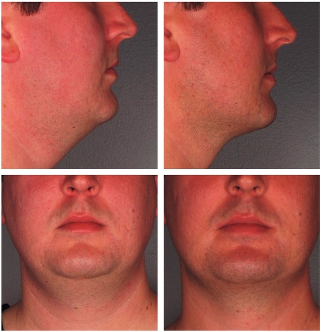 Male Facial Sculpting: Jaw Exerciser Vs. Fillers — The Med Spa