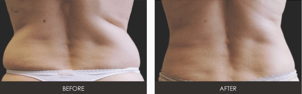WHY YOU SHOULD CHOOSE DR. SUNDIN FOR COOLSCULPTING?