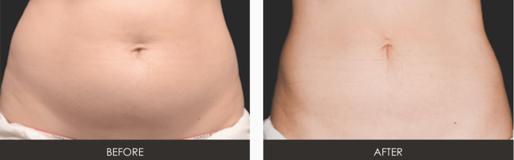 CoolSculpting in the Washington DC Area | Vienna | Tysons Church