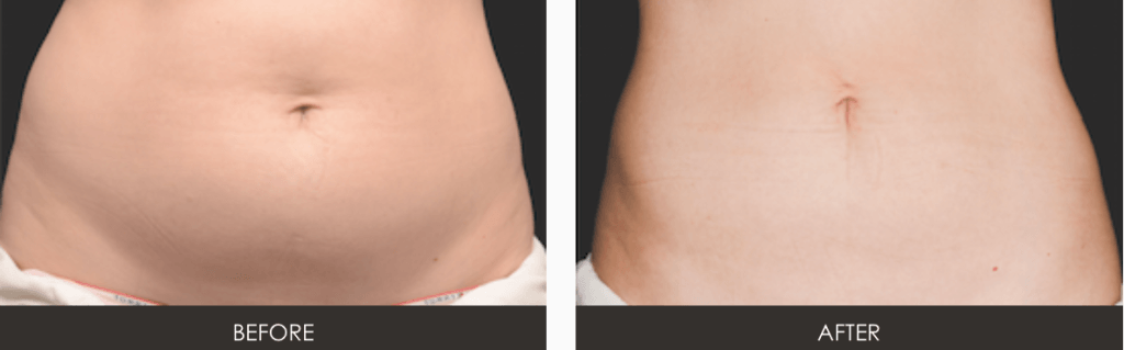 CoolSculpting Body Contouring