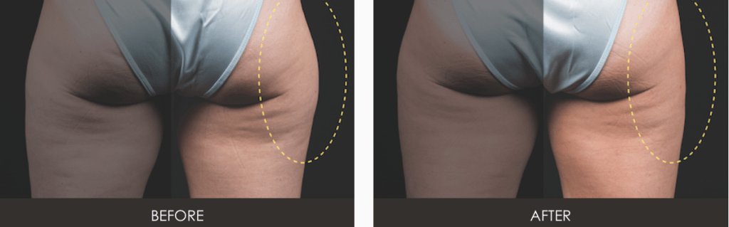 CoolSculpting Body Contouring Before and After Photos