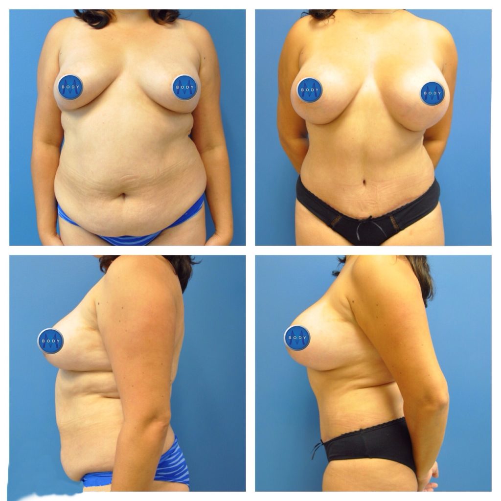 Give Your Boobs a Boost with a Non-Surgical Breast Lift - Contour Cosmetic  Clinics