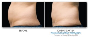 CoolSculpting Fat Removal in Richmond