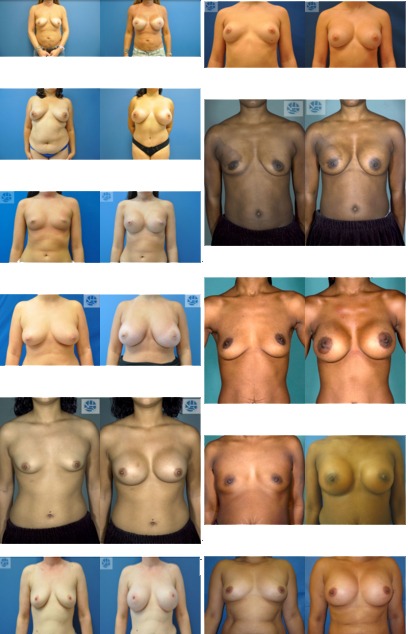Breast Augmentation Before and After Photos in Richmond