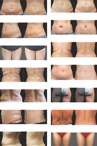 CoolSculpting Fat Removal Before and After Photos in Richmond