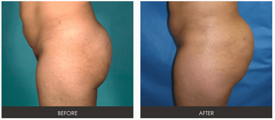 Brazilian Butt Lift  Fat Grafting Transfer Plastic Surgery