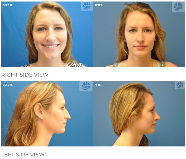 Rhinoplasty (Nose Job Surgery) Before and After Photos | Northern Virginia