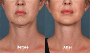 Kybella vs. CoolMini: Which Double Chin Treatment is Best? | Richmond