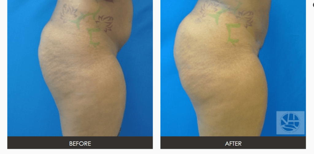 Fat Transfer Buttock Augmentation Before and After Photos | Richmond