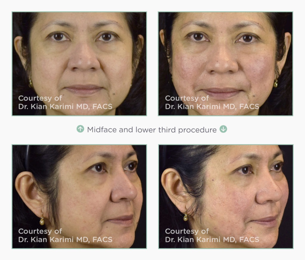 NovaThreads Non-Invasive Facelift Before and After Photos