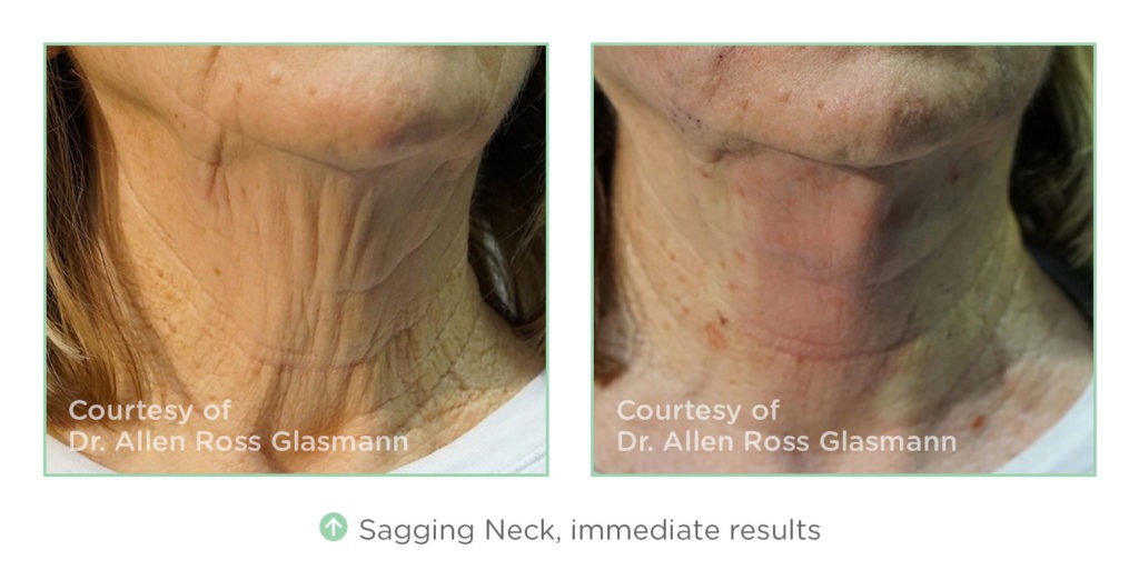 NovaThreads Non-Invasive Facelift Before and After Photos