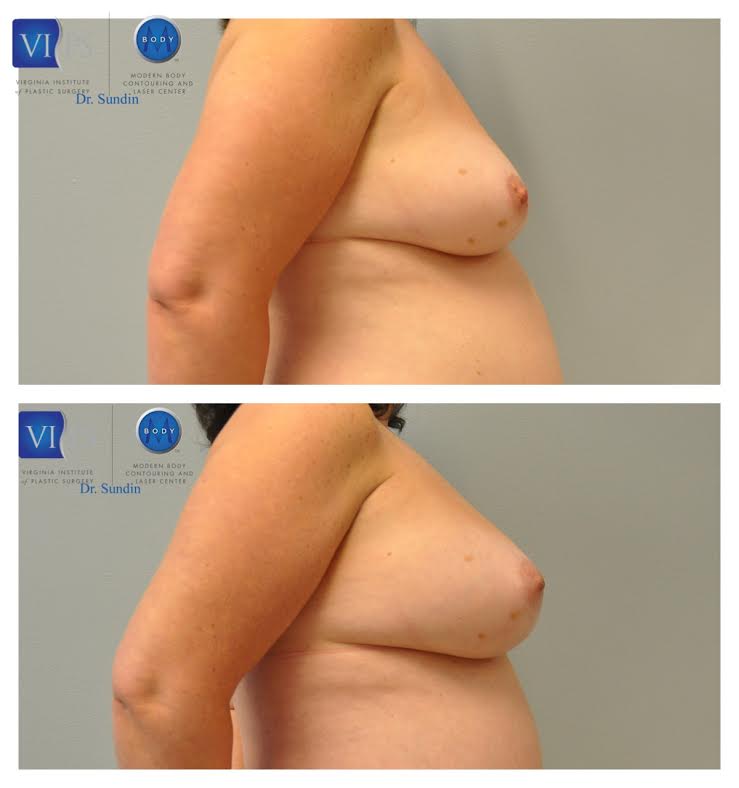 Increase Breast Augmentation with Fat Grafting, Northern Virginia