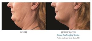 CoolSculpting vs. Kybella to Treat Double Chin | Fairfax | McLean