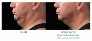 Coolsculpting for chin fat reduction before after photos