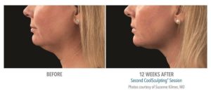 Coolsculpting for chin fat reduction before after pictures