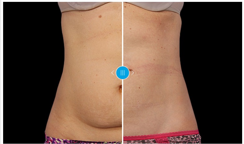 coolsculpting Archives - Northern Virginia Medical Spa