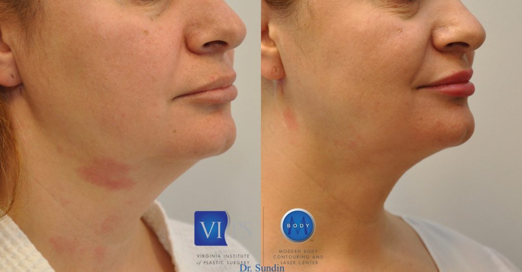 Advantages of J-Plasma Renuvion for the Face/Neck