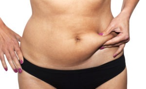 Liposuction Surgery Before And After Photos
