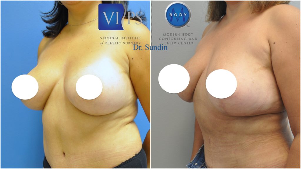 Breast Revision and Reconstruction