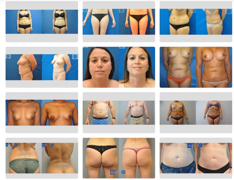 How much does In Office &#8220;Little Lipo&#8221; Liposuction cost? 