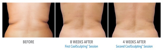 What procedure removes back fat folds, extra skin, bra strap fat