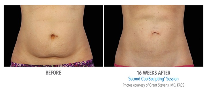 Elite Body Sculpting With CoolSculpting