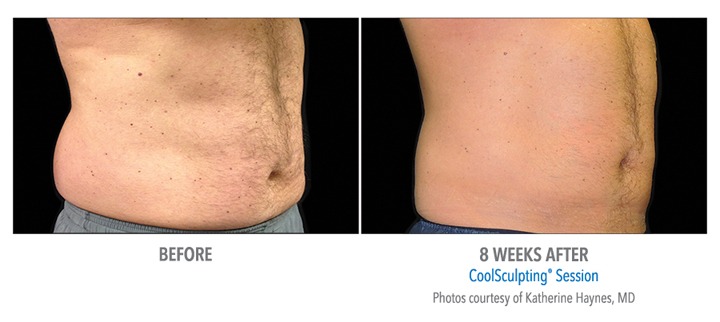 Do You Lose Weight With CoolSculpting?