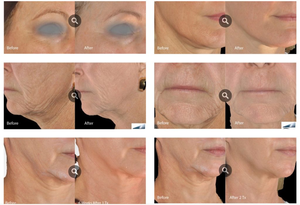 Microneedling Before And After Photos