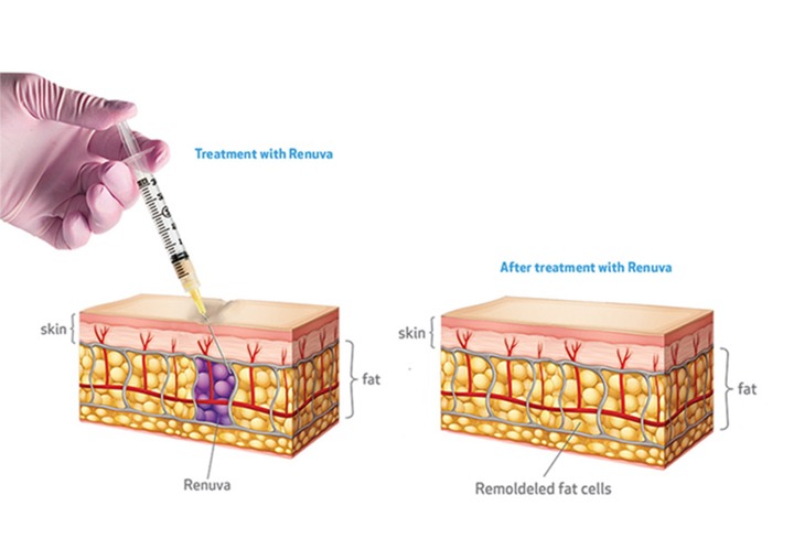 Collagen Induction Therapy With Renuva