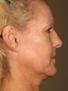 Ultherapy Skin Tightening Before and After Photos
