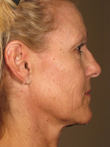 Ultherapy Skin Tightening Before and After Photos